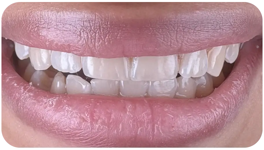 تبييض الأسنان (1)