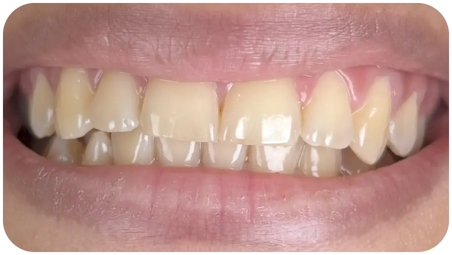 تبييض الأسنان